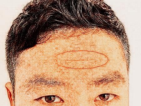 面相学中面对额头有疤的人该如何解读？